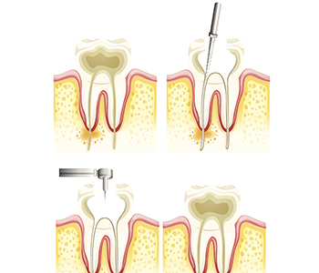 Illustration of root canal treatment