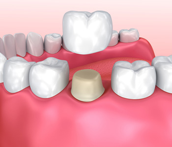 Illustration of dental crown