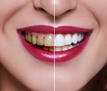 Before and after cosmetic dental treatment