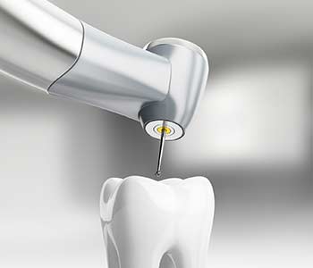 3D model of Root canal