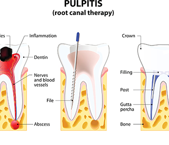 Pulpitis root canal therapy