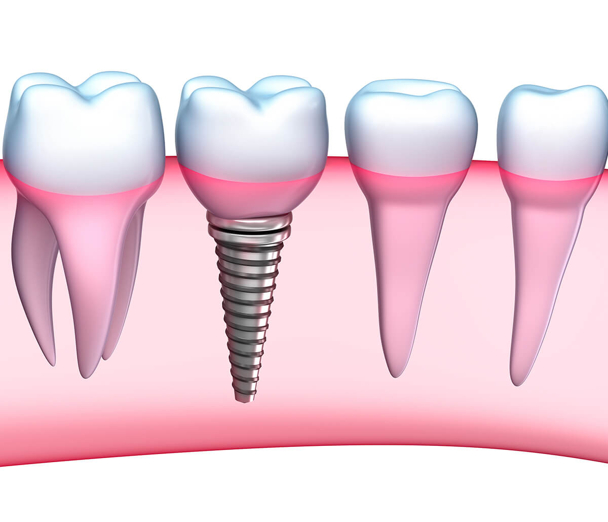 Implants for Teeth in Alpharetta GA Area