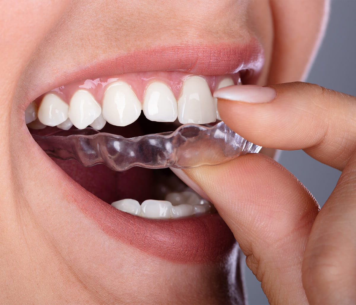 Invisalign Teeth Treatment in Alpharetta GA Area