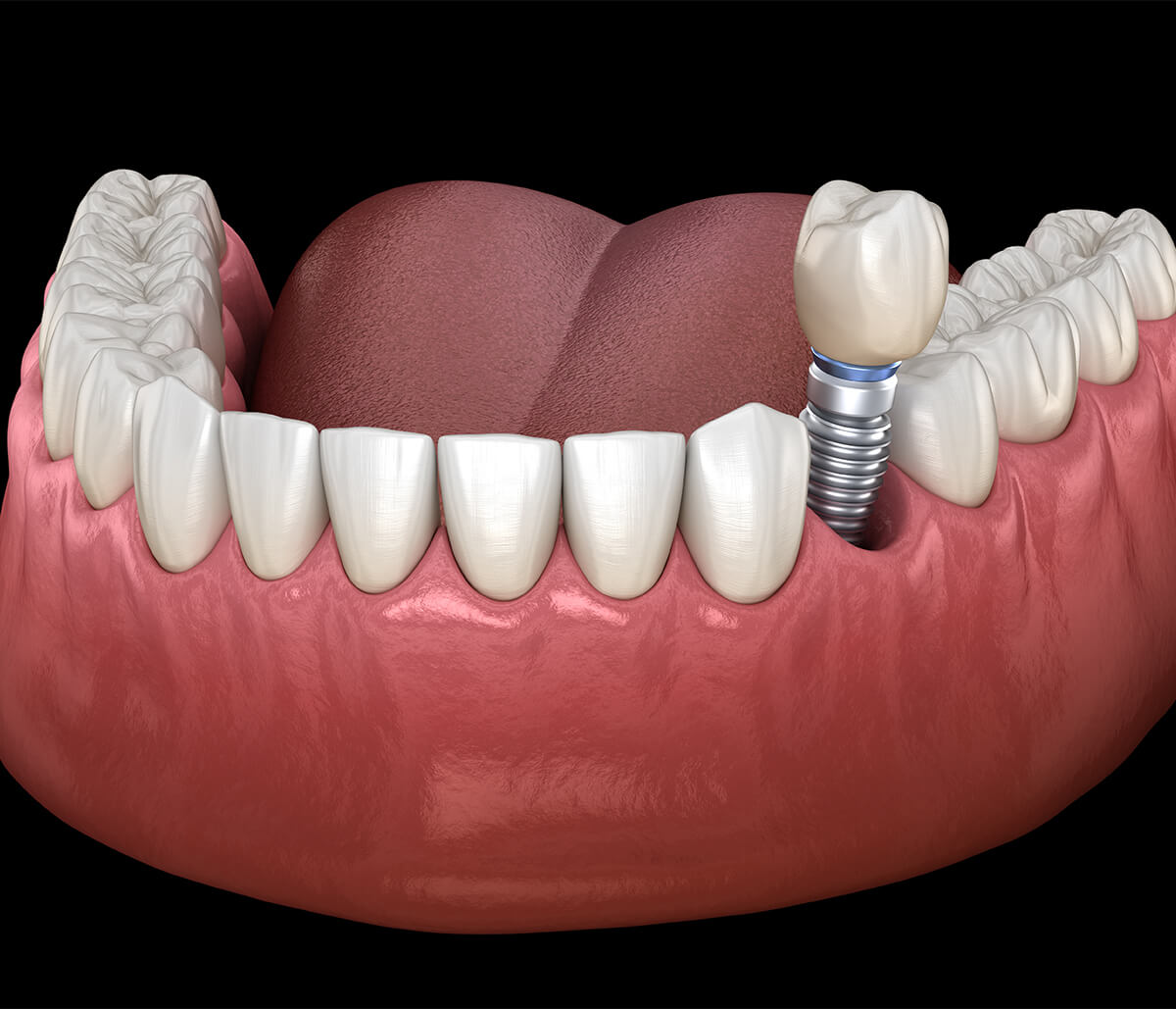 Teeth Implants Dentist in Alpharetta Area