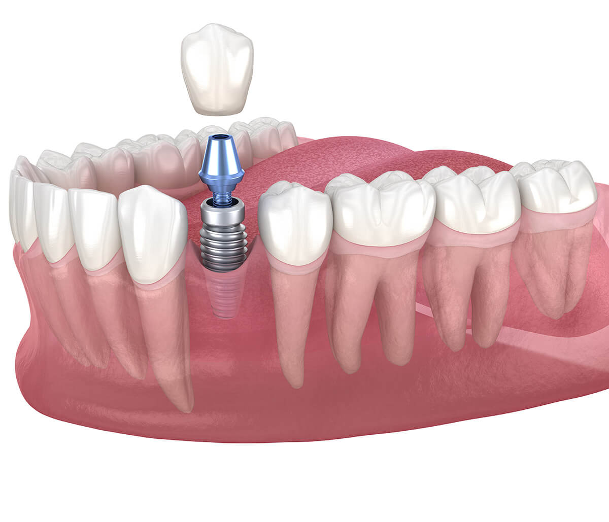 Good Dental Implants in Alpharetta GA Area